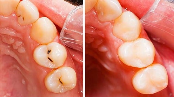 Exemple des effets de l'odontologie