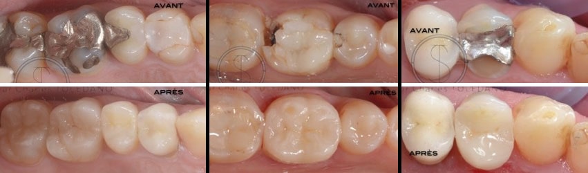 Exemples d'inlays/onlays/overlays